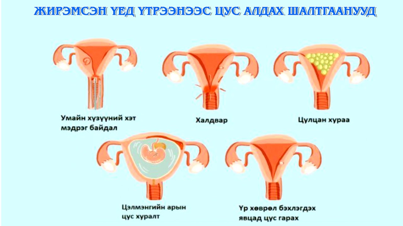 ЖИРЭМСНИЙ ЭРТ ХУГАЦААНД ЯАГААД ҮТРЭЭНЭЭС ЦУС ГАРДАГ ВЭ? /НӨАГ-ын Эх барих эмэгтэйчүүдийн эмч У.Халиун/