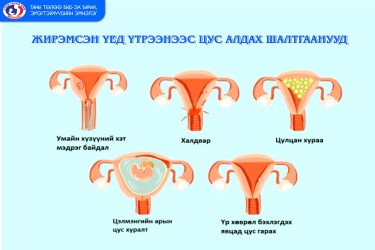 ЖИРЭМСНИЙ ЭРТ ХУГАЦААНД ЯАГААД ҮТРЭЭНЭЭС ЦУС ГАРДАГ ВЭ? /НӨАГ-ын Эх барих эмэгтэйчүүдийн эмч У.Халиун/